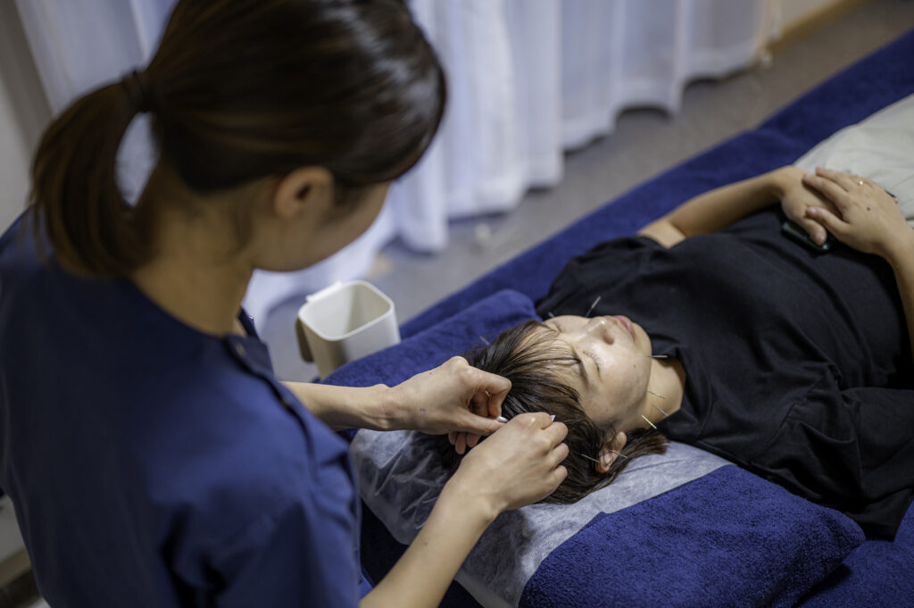 秋田県でも当院だけの肌育できる美容鍼の施術です